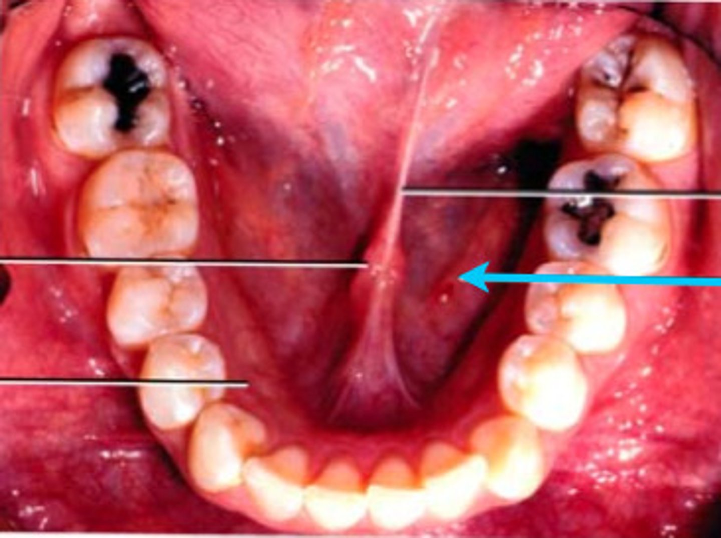 <p>Structure on the floor of the mouth that appears as a v shaped ridge of tissue on each side of the frenum, that FUNCTION to empty the sublingual glands</p>