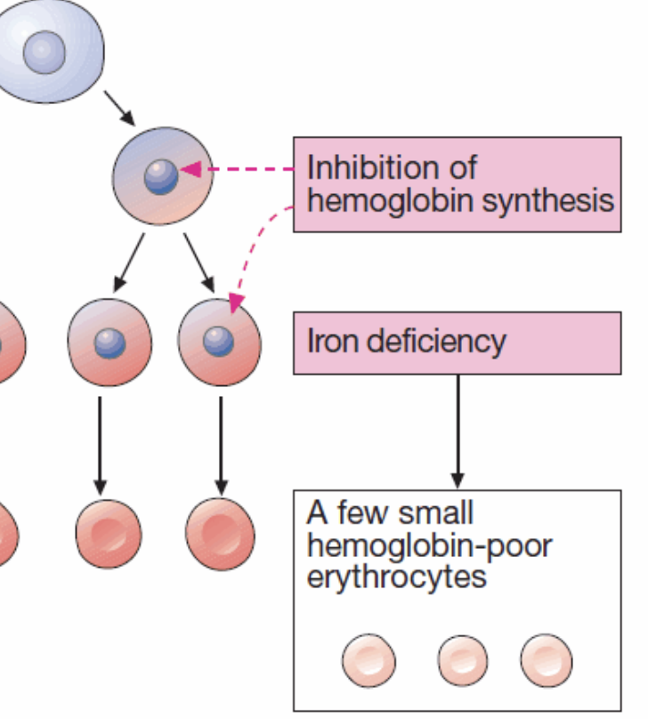 <p>microcytic anemia</p><ul><li><p>low levels of iron→ lack of hemoglobin→ inhibition of hemoglobin synthesis→ small hemoglobin-poor erythrocytes (pale in color)</p></li></ul><p></p>