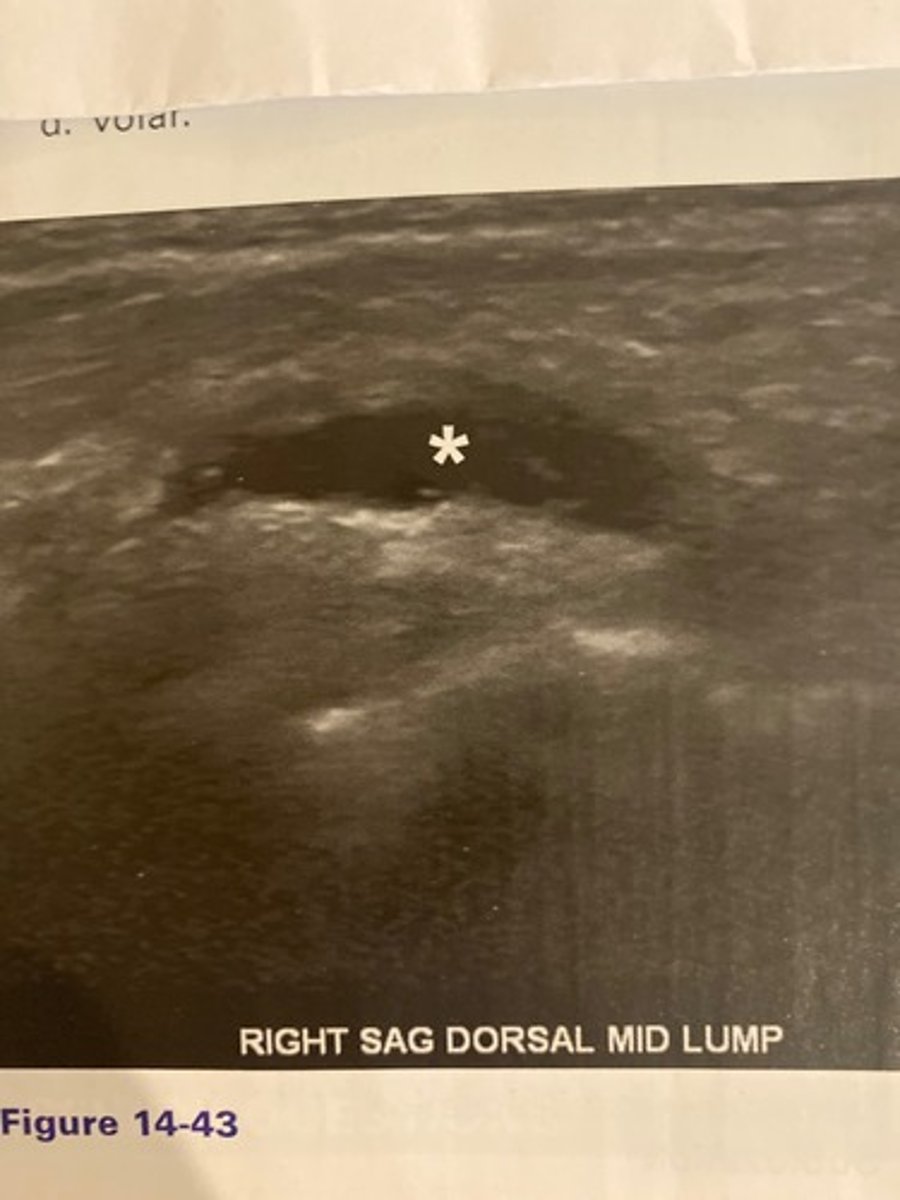 <p>What is the painless abnormality noted in the wrist of the patient in Figure 14-43?</p><p>a. Baker cyst</p><p>b. Ganglion cyst</p><p>c. Pilonidal cyst</p><p>d. Lipoma</p>