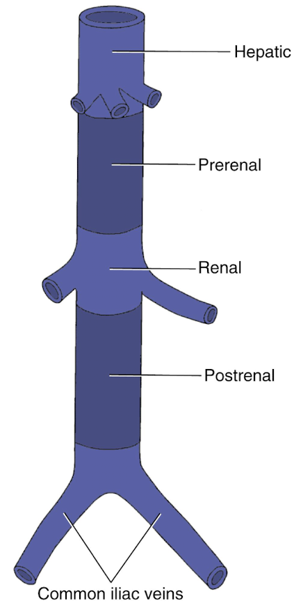<ol><li><p>hepatic (posterior to liver; HVs empty into IVC</p></li><li><p>prerenal (before renal veins)</p></li><li><p>renal (renal veins and other tributaries empty into IVC)</p></li><li><p>postrenal</p></li></ol><p></p>