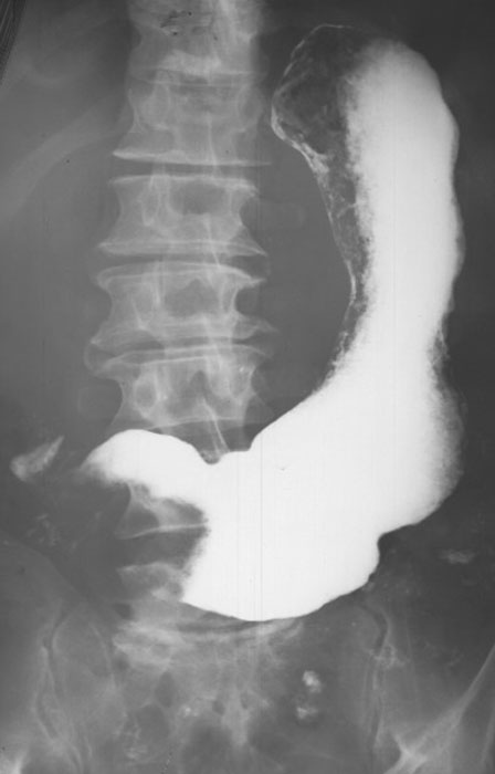 <p>What is the radiographic appearance of proliferative type of gastric carcinoma?</p>