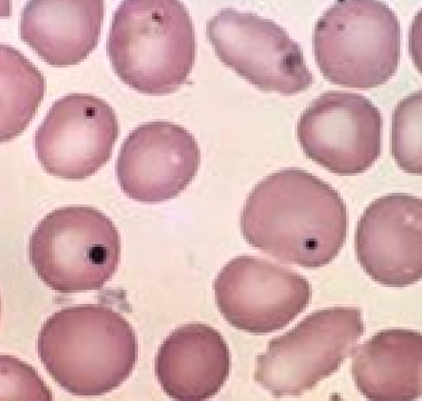 * basophilic nuclear remnant
* causes: Splenectomy, Chemotherapeutics, Glucocorticoids, Regenerative responses