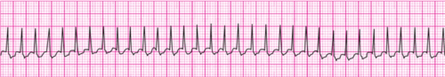 <p>Supraventricular tachycardia</p>