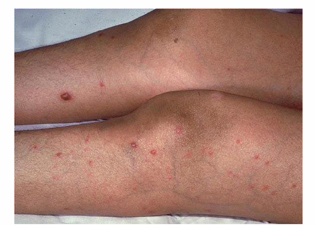 <p>-painful, macronodular lesions</p><p>-if present, lesions suggest disseminated candidiasis and the patient should be evaluated/treated for other sites of infection</p>