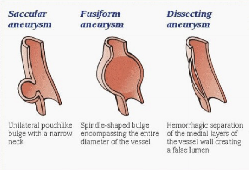 <ul><li><p>Saccular aneurysm</p></li><li><p>Fusiform aneurysm</p></li><li><p>Dissecting aneurysm </p></li></ul><p></p>
