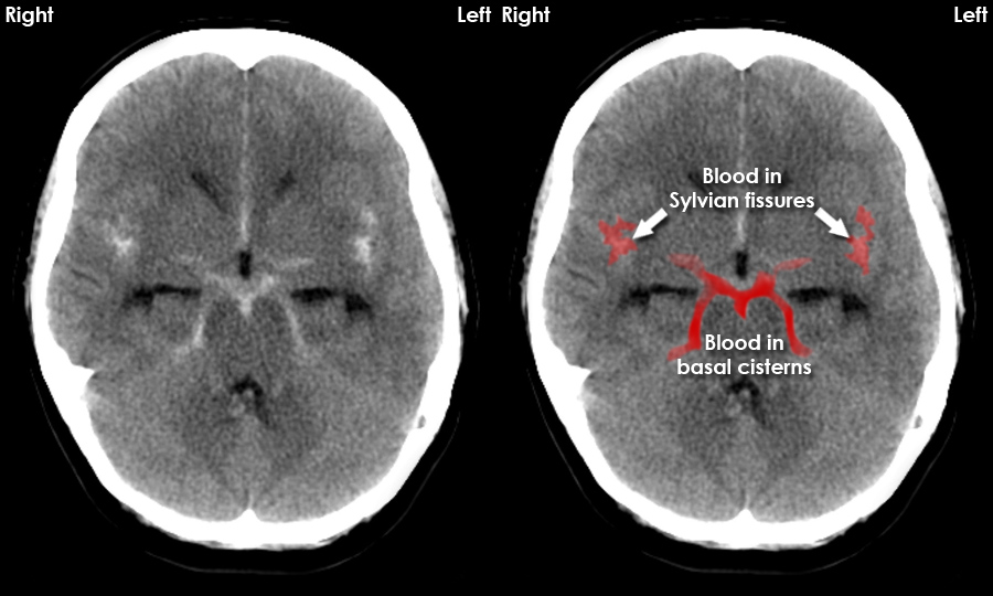 <p>Subarachnoid haemorrhage pathology </p>