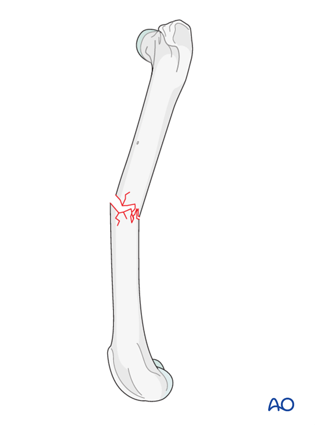 <ul><li><p>a fracture that does not run completely through the bone </p></li><li><p>a nondisplaced partial fracture </p></li></ul><p></p>