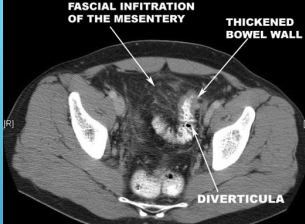 <p><strong>Diverticulitis: Diagnosis</strong></p><p>-Labs → CBC </p><p>-Imaging → Abdominal __ with oral/IV ________ (preferred imaging)</p><ul><li><p>Localized bowel wall ___________ (>4mm) </p></li><li><p>Increases soft tissue density within pericolonic fat (fat stranding) </p></li><li><p>Presence of _________</p></li><li><p>Can also find complications if present </p></li></ul><p>-___________ should be avoided during acute diverticulitis d/t risk of _________</p><p>-After resolution of symptoms (_-_ weeks) a colonoscopy can be performed if the pt hasn’t had one within the previous year </p><p></p>