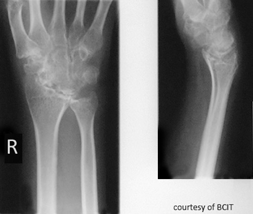 <p>most common in females between 25 - (45)- 58). initial sites are bilateral hands, feet then other joints and organs. Elderly occurs in (60+, young in 16-40. Juvenile 16. an autoimmune disease which affects both joints and ST. a non-bacterial inflammatory disease that is polyarthritis, non-specific and can affect any. symptoms are painful swollen joints, fever, fatigue, anemia, chronic pain, weight loss. secondary symptoms = inflammation of nerve ending, vessel walls, and respiratory tract. images will show a rarefaction or sites of osteoporosis. there is no known cure, treatment goal is to alleviate symptoms.  </p>