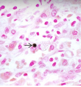 <p><strong>michaelis-gutmann bodies</strong> = laminated mineralized concretions resulting from deposition of calcium in enlarged lysosomes</p>