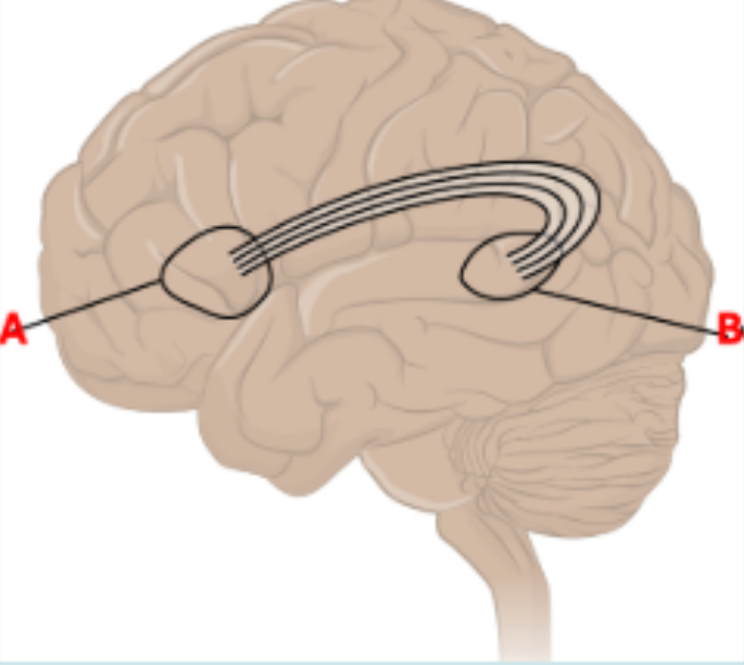 <p>A woman has suffered from a stroke (me.) She is unable to follow simple instructions or answer basic questions. A question is asked of her, and she answers with a stream of words unrelated to the question or to each other. Some of these words are new and without meaning. Which of the two labeled areas in the picture below did it?</p>