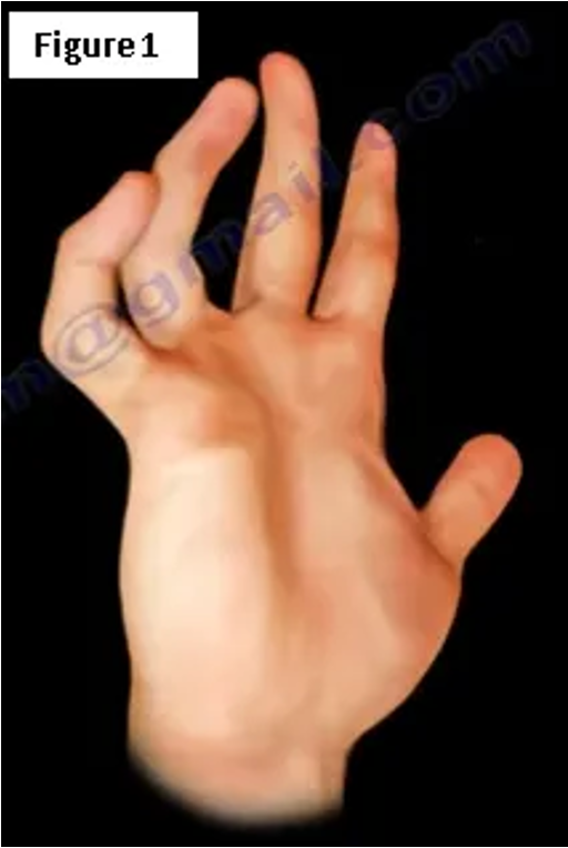 <p>•Claw hand posture</p><p>•Froment’s sign</p><p>•Wartenberg’s sign</p><p>•Atrophy intrinsics and hypothenar</p><p>•Loss of power grip&nbsp; and key pinch</p>