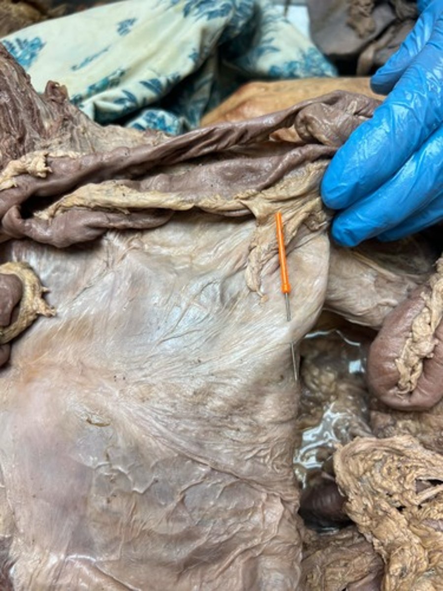 <p>lateral umbilical fold</p>