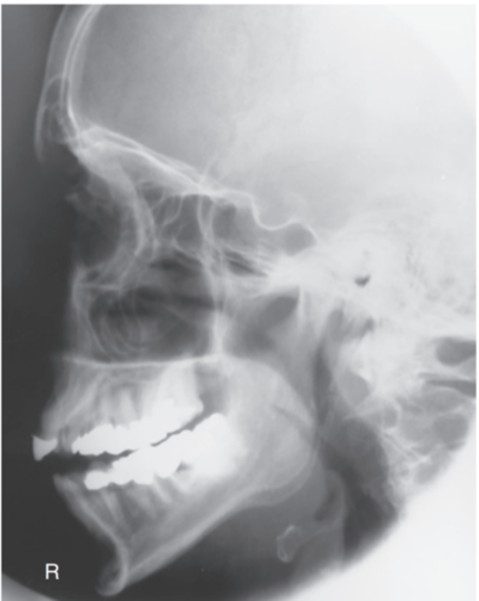 <p>Position:</p><p>• An accurately positioned lateral image of the facial bones demonstrates no rotation or tilt.</p><p>• Rotation is evident by anterior and posterior separation of symmetric vertical bilateral structures such as the mandibular rami and greater wings of the sphenoid.</p><p>• Tilt is evident by superior and inferior separation of the orbital roofs (plates).</p>