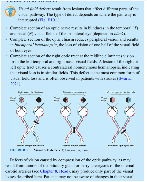 <p>Visual field defects result from lesions that affect different parts of the visual pathway. The type of defect depends on where the pathway is interrupted (Fig. B10.1): • Complete section of an optic nerve results in blindness in the temporal (T) and nasal (N) visual fields of the ipsilateral eye (depicted in black). • Complete section of the optic chiasm reduces peripheral vision and results in bitemporal hemianopsia, the loss of vision of one half of the visual field of both eyes. • Complete section of the right optic tract at the midline eliminates vision from the left temporal and right nasal visual fields. A lesion of the right or left optic tract causes a contralateral homonymous hemianopsia, indicating that visual loss is in similar fields. This defect is the most common form of visual field loss and is often observed in patients with strokes (Swartz, 2021).</p><p>Defects of vision caused by compression of the optic pathway, as may result from tumors of the pituitary gland or berry aneurysms of the internal carotid arteries (see Chapter 8, Head), may produce only part of the visual losses described here. Patients may not be aware of changes in their visual fields until late in the course of disease because lesions affecting the visual pathway often develop insidiously.</p>