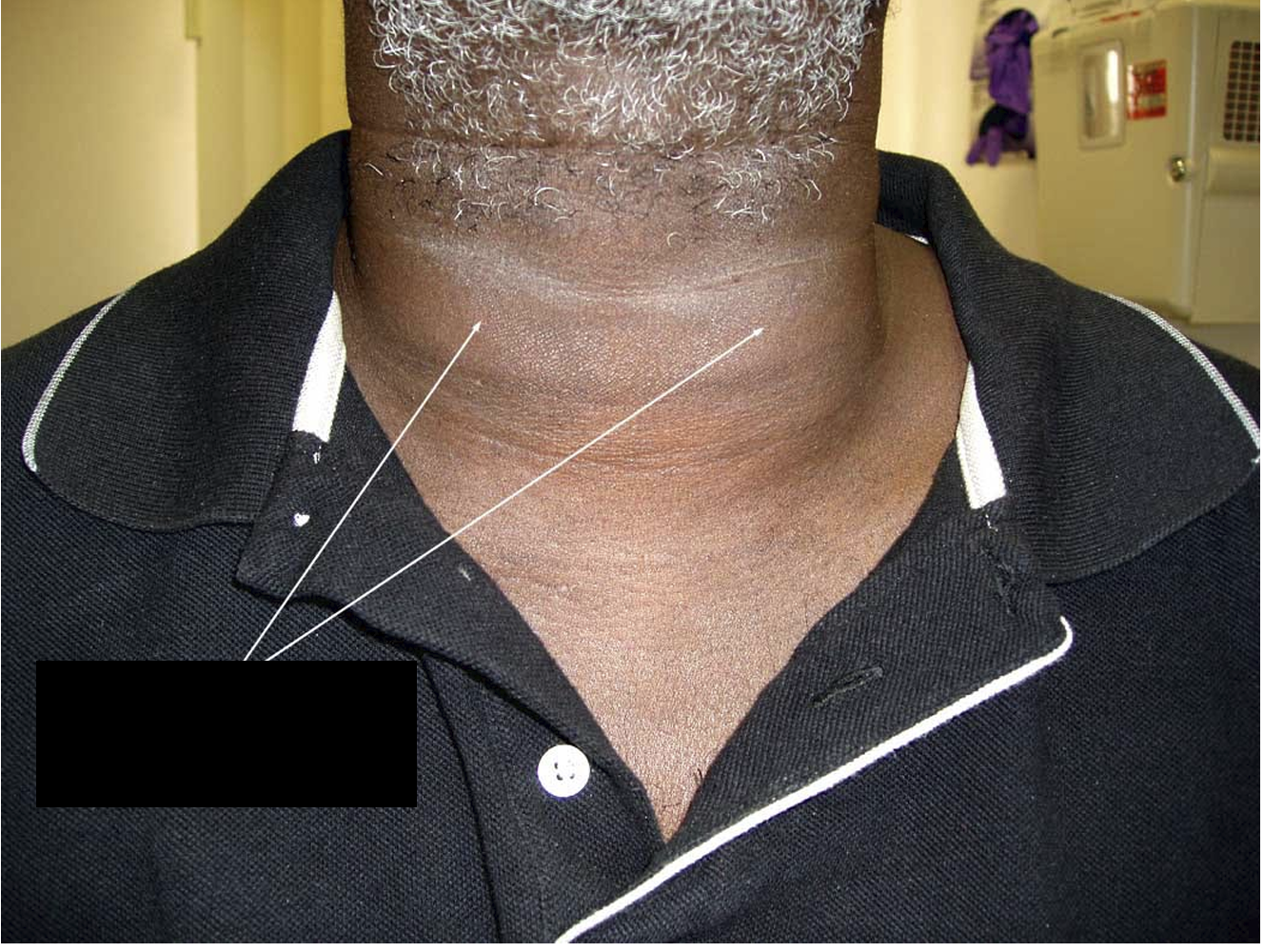 <p>What symptom is this from what disease</p>