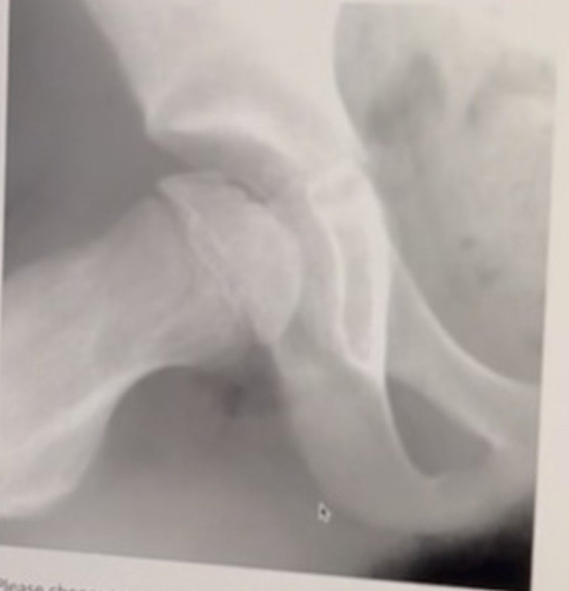 <p>6 year old male with right hip pain.</p><p>The most likely diagnosis is:</p><p>Septic arthritis</p><p>Legg Calve Perthes</p><p>Slipped capital femoral epiphysis</p><p>Acetabular dysplasia</p>
