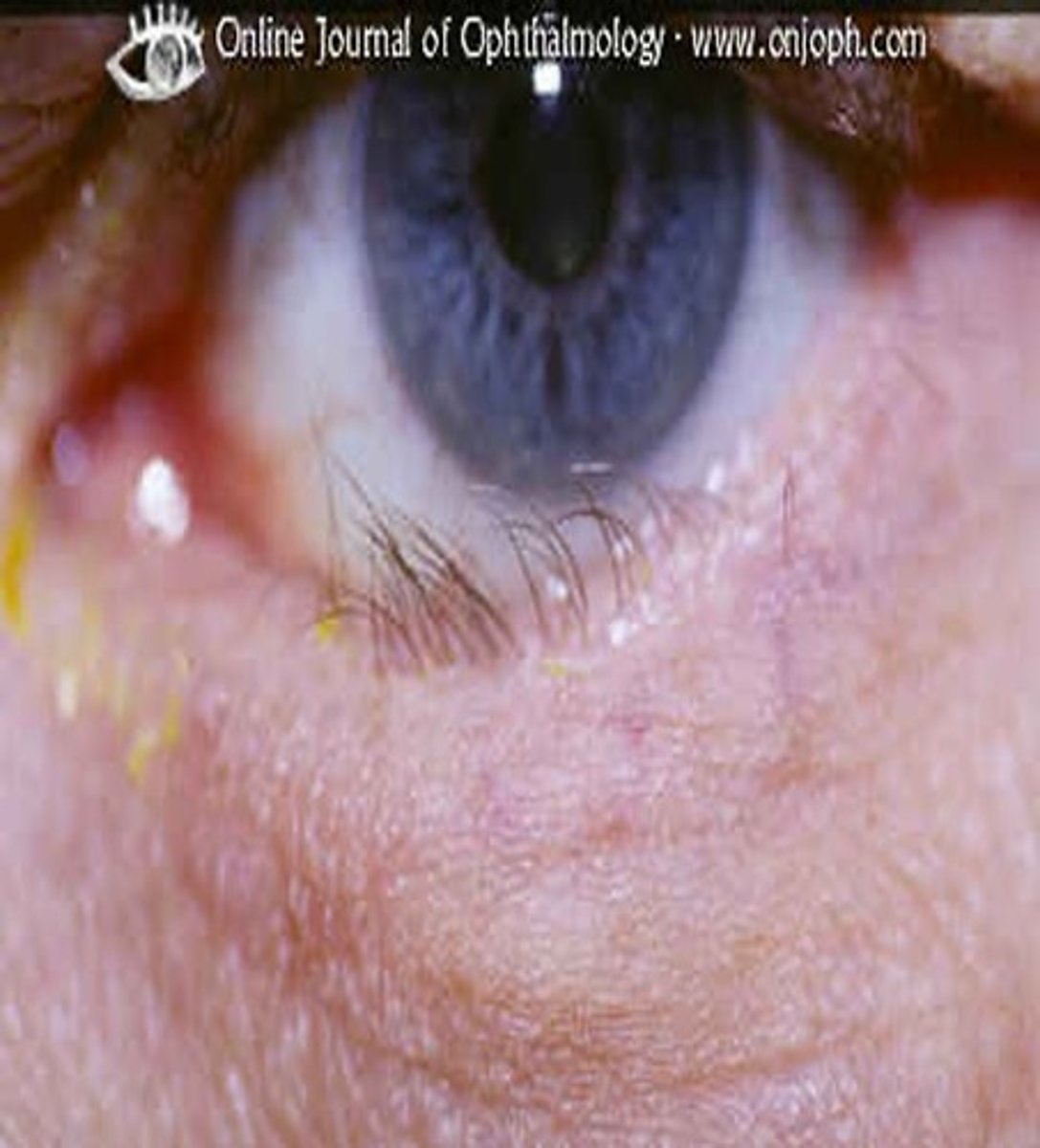 <p>inward turning of the lid margin</p><p>- normally due to scaring or inflammation</p><p>- can cause damage and affect vision due to inward lashes</p>