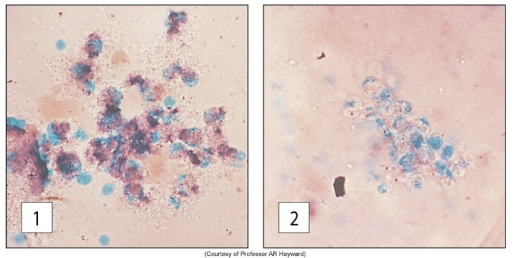 <p>this is an image of the results of 2 different patient samples that underwent the NBT dye test. which one is of the <strong>normal</strong> patient (no CGD)?</p>