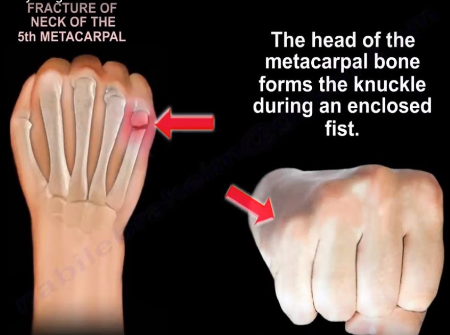 <p>-4/5th digit fx, typically to metacarpophalangeal neck</p><p>-ulnar gutter orthosis</p>