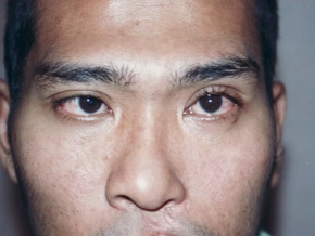 <p>medial deviation of eye, limited eye abduction, diplopia (double vision)</p>