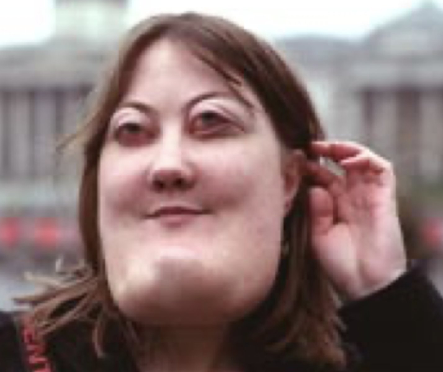 <p>- Bilateral multilocular radiolucencies</p><p>- Autosomal dominant inheritance</p><p>- Classic facies, Proptotic eyes, Lengthening of ramus, Prominent condyle</p><p>- Usually resolve after puberty</p>