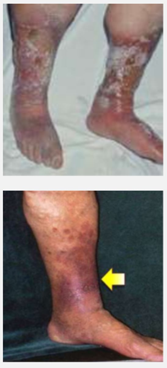 <p>MOST COMMON TYPE OF CHRONIC WOUND</p><p>caused by incompetent valves in deep, superficial, and/or perforator veins</p><p>- regurgitation</p><p>- increased venous pressure</p><p>- damage to capillaries</p><p>hemosiderin staining--> edema and seepage of red blood cell components and fibrinogen into surrounding tissues</p><p>CHARACTERISTICS:</p><p>- gaiter area</p><p>(medial supramalleolar aspect of LE)</p><p>- edema</p><p>- shallow, irregular borders</p><p>- mod to heavy exudate, weeping</p><p>- little to no eschar</p>