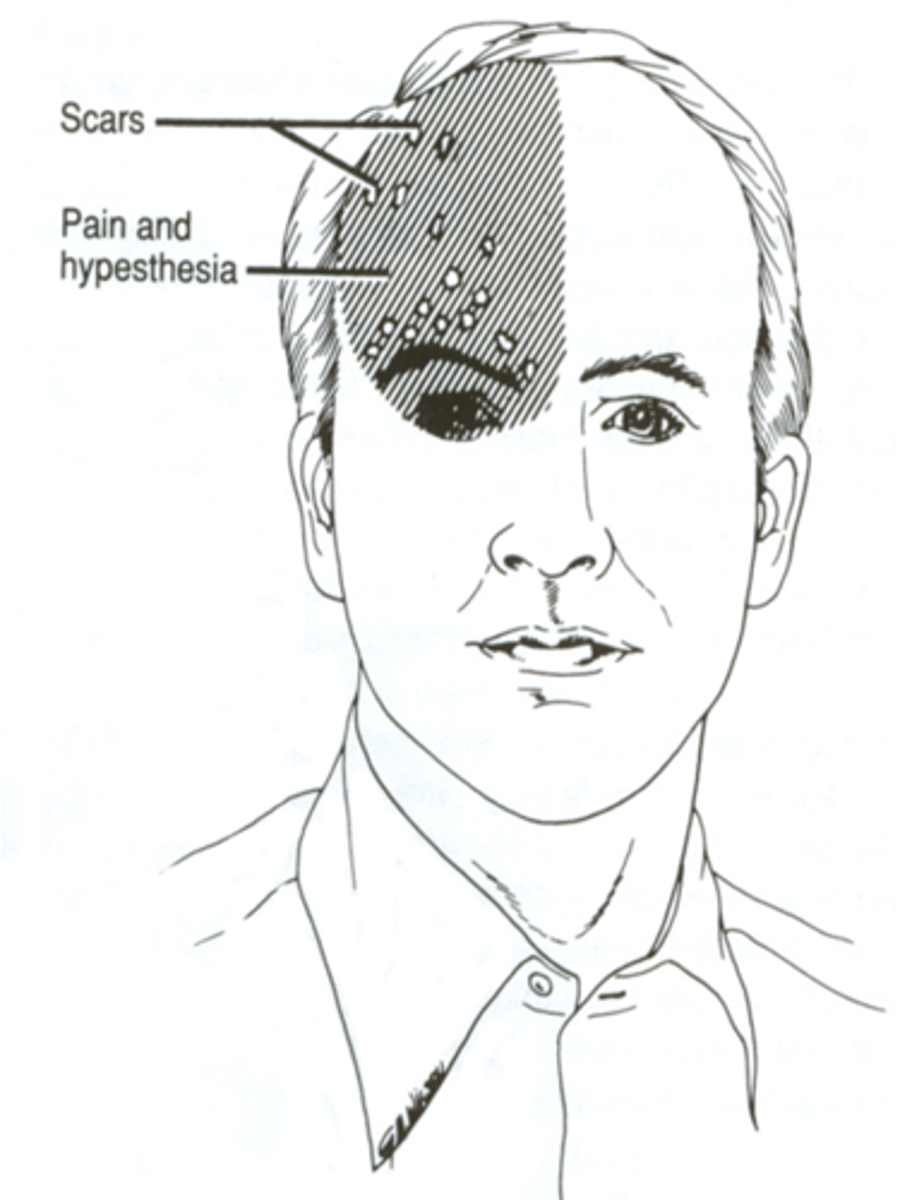 <p>cranial neuralgia - often postherpetic</p>