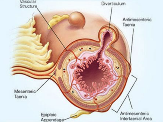 <p><strong>Diverticular Disease: Pathophysiology </strong></p><p>-Associated with increased intracolonic _________, abnormal neuromuscular function, and alterations in intestinal _______</p><p>-Diverticulosis </p><ul><li><p>Tend to form at ____ points in the colonic wall where ____ _____ penetrate the circular muscle layer </p></li><li><p>Exaggerated segmentation ___________ → increases intraluminal pressure → _________ of the mucosa and submucosa through the muscle layer </p></li><li><p>Laplace’s law → wall pressure increases as diameter of a cylindrical structure __________</p></li></ul><p></p>