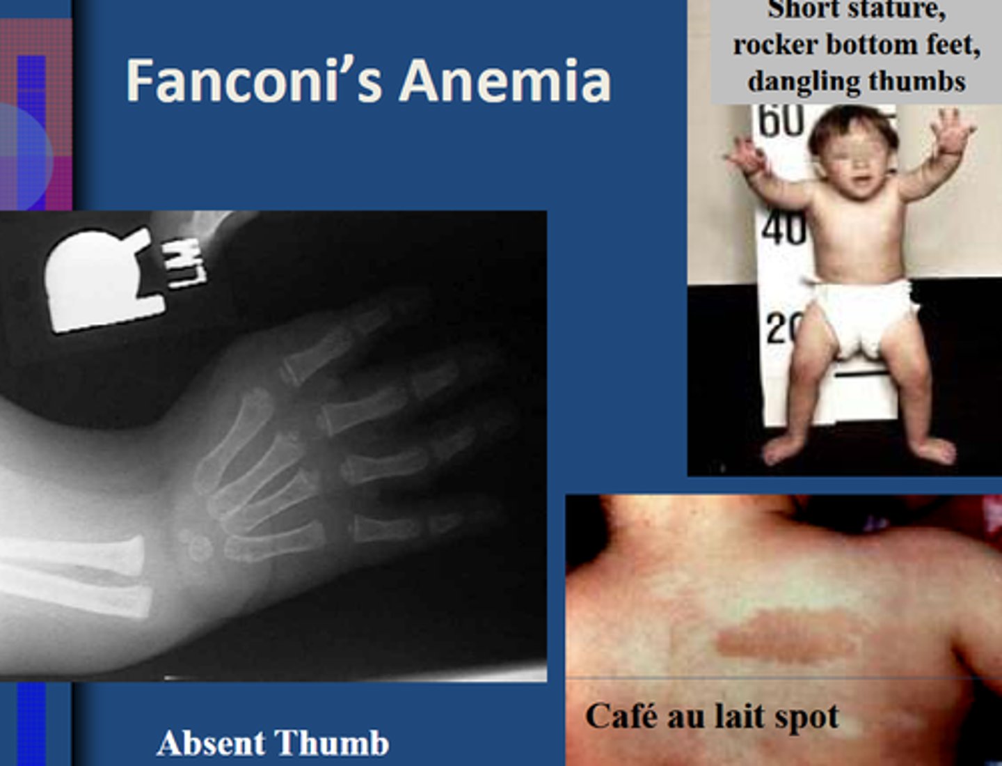 <p>Fanconi anemia (genetic loss of DNA crosslink repair; often progresses to AML)</p>