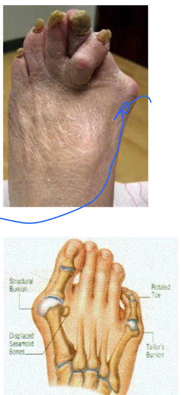 <p>Angle on the 1 MTP (hallux moves laterally relative to metatarsals), &gt;15 degrees = hallux valgus </p>