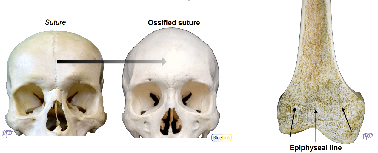<p>An <strong><u>ossified joint</u></strong> that is immobile, such as ossified sutures and epiphyseal lines</p>