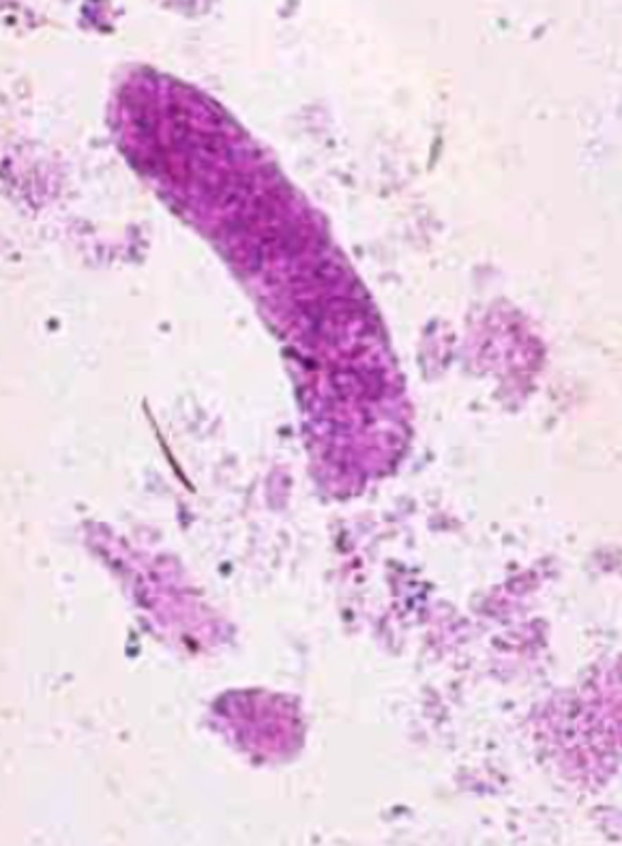 <p>- Most commonly seen</p><p>- Due to degeneration of renal epithelial casts or WBC casts</p><p>- Course or fine</p>