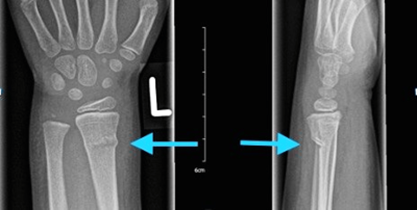 <p>fracture does not traverse through entire bone (greenstick)</p>