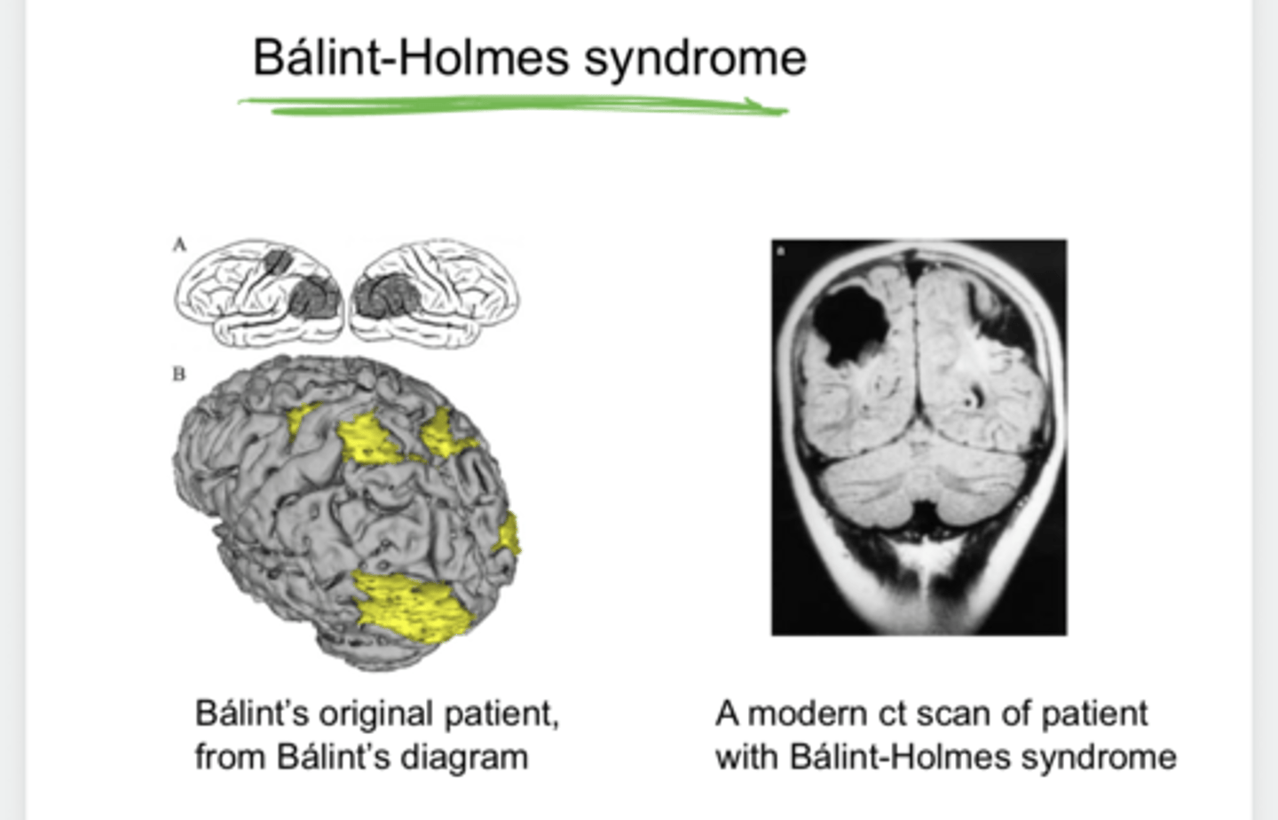 <p>Modern CT Scan of a Patient with Balint-Holmes Syndrome (Pic)</p>