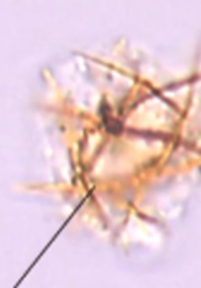 <p>- ABNORMAL</p><p>- acidic</p><p>- when urine bilirubin exceeds its solubility conc</p><p>- yellow-brown needles</p><p>- insoluble in alcohol</p><p>- POS BILI RESULT accompaniment</p><p>-seen in hepatic disorders</p>