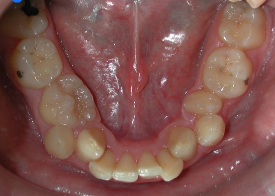 <p>Genetic bone-tooth discrepancy</p><p>Volumetric conflict between the size of the teeth (large) and the size of the bony bases (small)</p>