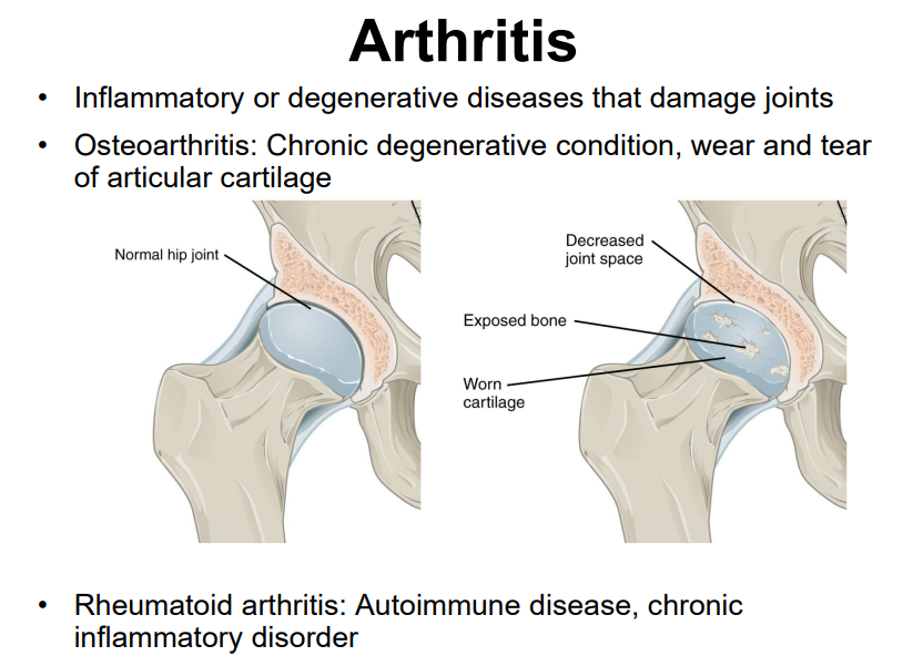 <ul><li><p>a lot of use of articular cartilage, aging, autoimmune diseases, bacterial infections, unknown (genetic) causes</p></li></ul><p></p>