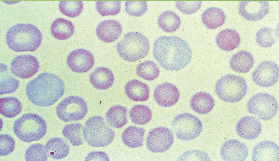 <p>This is an example of what kind of cell abnormality? </p>
