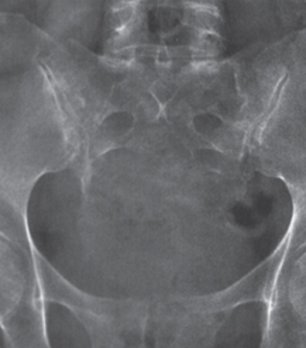 <p>What is the most likely diagnosis?</p><p>Sacroiliitis</p><p>A sacral tumor</p><p>Constipation</p><p>Osteoporosis</p><p>Uterine malignancy</p>