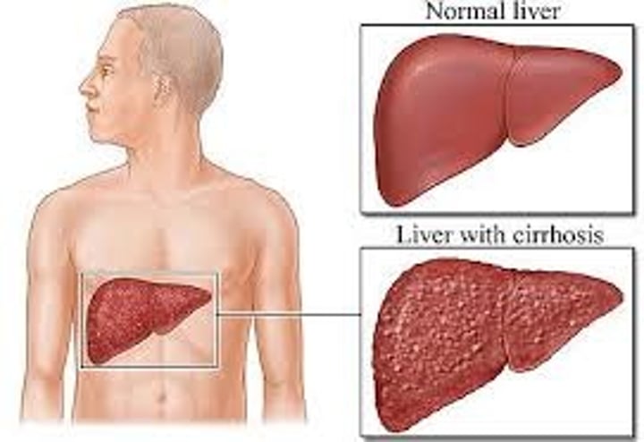 <p>scarring/hardening of the liver<br>- decreases liver function</p>
