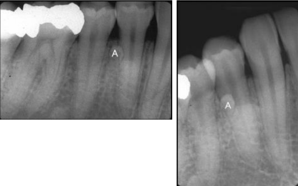<p>where is the supernumerary tooth A relative to #28</p>