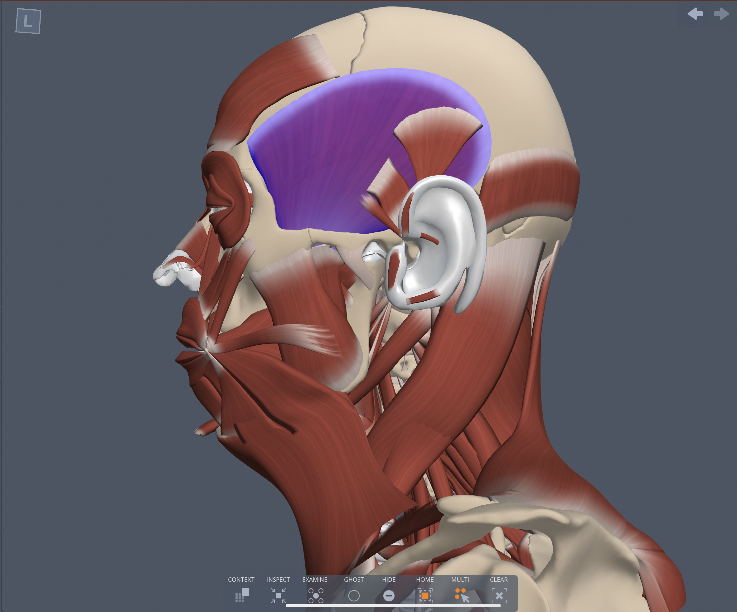 Insertion of the Temporalis muscle 