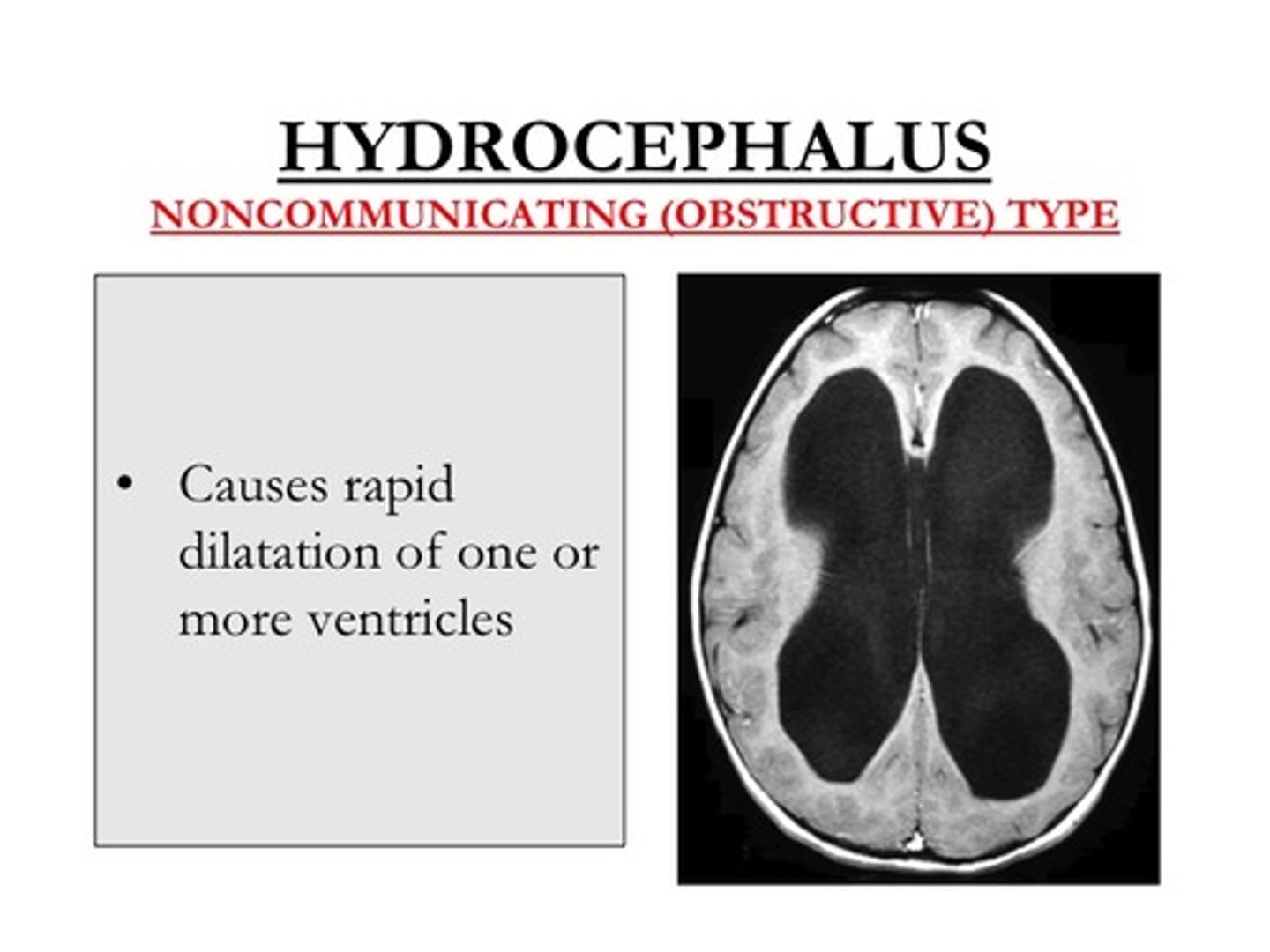 <p>Life-threatening complication from brain lesions blocking CSF flow leading to ↑ ICP; dilated &amp; nonreactive pupil, autonomic dysfunction, loss of brainstem reflexes, coma</p>
