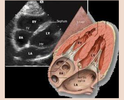 <p><span style="color: #000000">This window may provide the only achievable view in technically difficult patients such as those with chronic obstructive pulmonary disease or who are receiving mechanical ventilation.</span><span style="color: #000000"><br></span><span style="color: #000000">• The patient is supine and if possible, the knees are slightly bent to reduce abdominal wall tension.</span><span style="color: #000000"><br></span><span style="color: #000000">• The transducer is placed below and slightly to the right of the xiphisternum.</span><span style="color: #000000"><br></span><span style="color: #000000">• The side marker is in the 3 o’clock position and the transducer is tilted anteriorly. It may be necessary to push slightly downwards into the abdomen in order to achieve this scan plane.</span><span style="color: #000000"><br></span><span style="color: #000000">• The subcostal view shows the Inferior Vena Cava (IVC) in a long axis.</span></p>