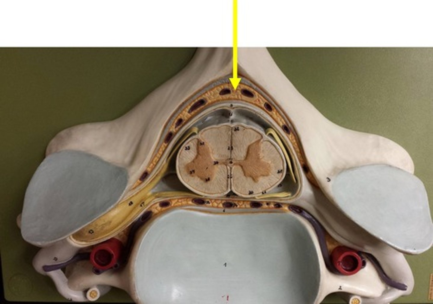 <p>space between the dura mater and the wall of the vertebral canal</p>