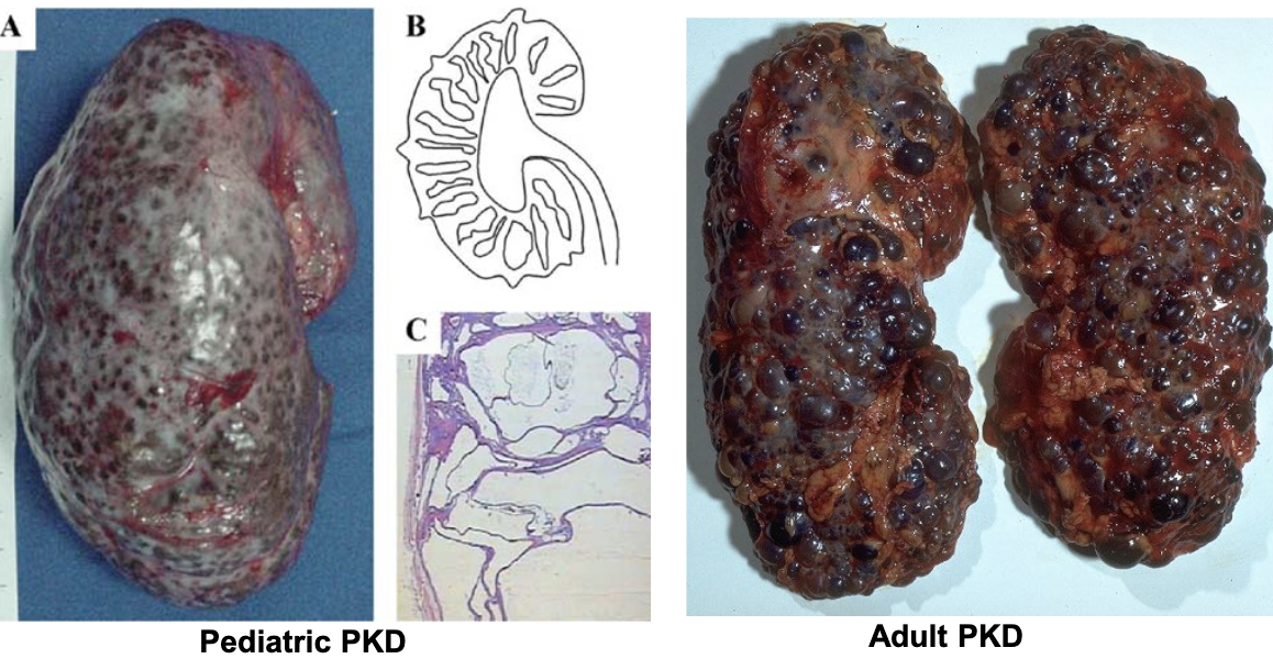 <p>polycystic kidney disease is an example of too much</p>