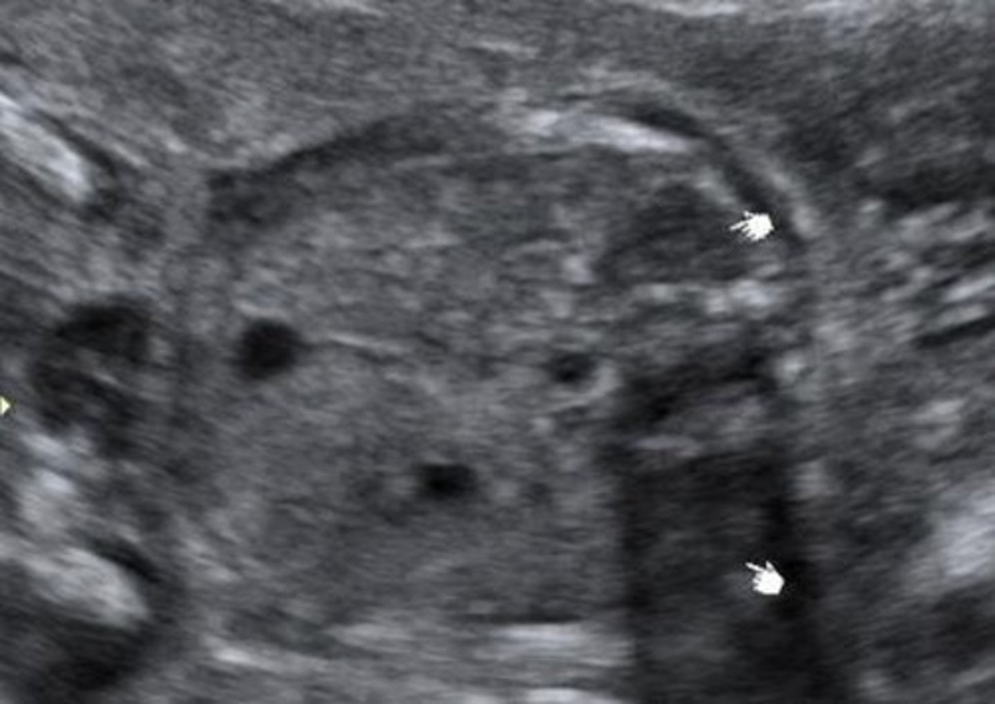 <p>Bilateral renal agenesis</p><p>Oligohydraminios</p><p>Pulmonary hypoplasia</p><p>Facial/hand/feet anomalies</p>