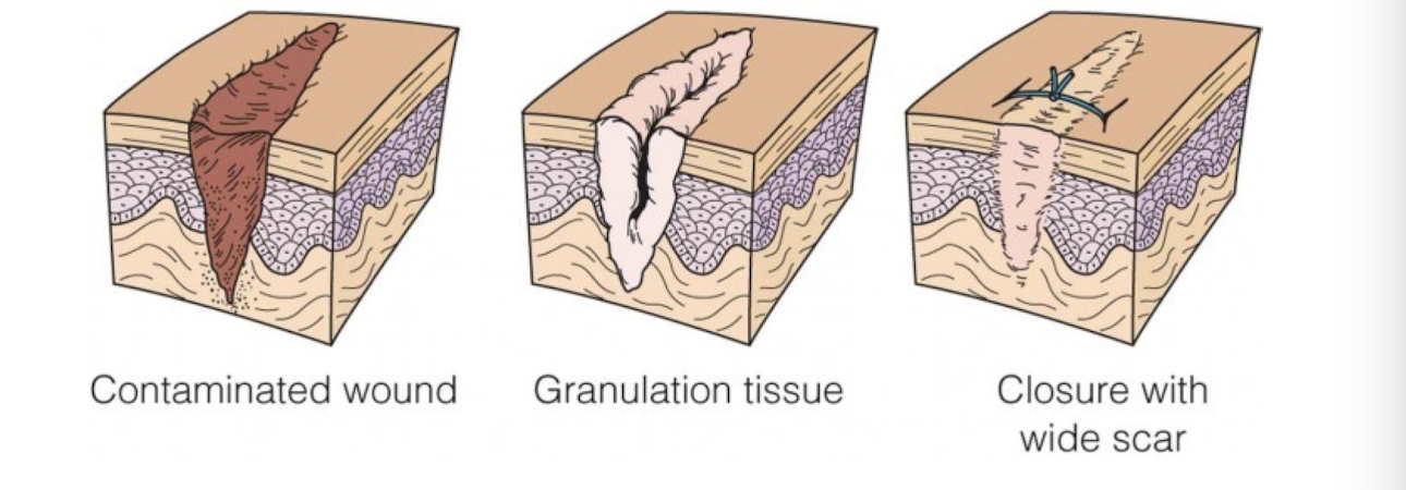 <p>What form of healing occurs <strong>when a contaminated wound is left open for a period of time before being surgically closed?</strong></p><p>ie.<strong> dog bites, infection</strong></p>