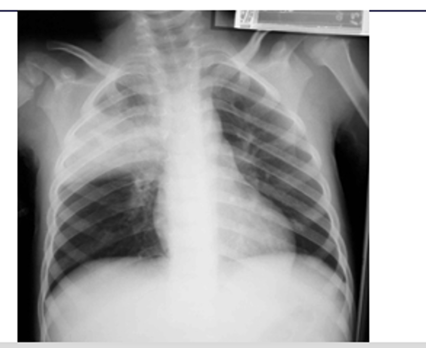 <p>RUL pneumonia with air bronchogram sign</p>